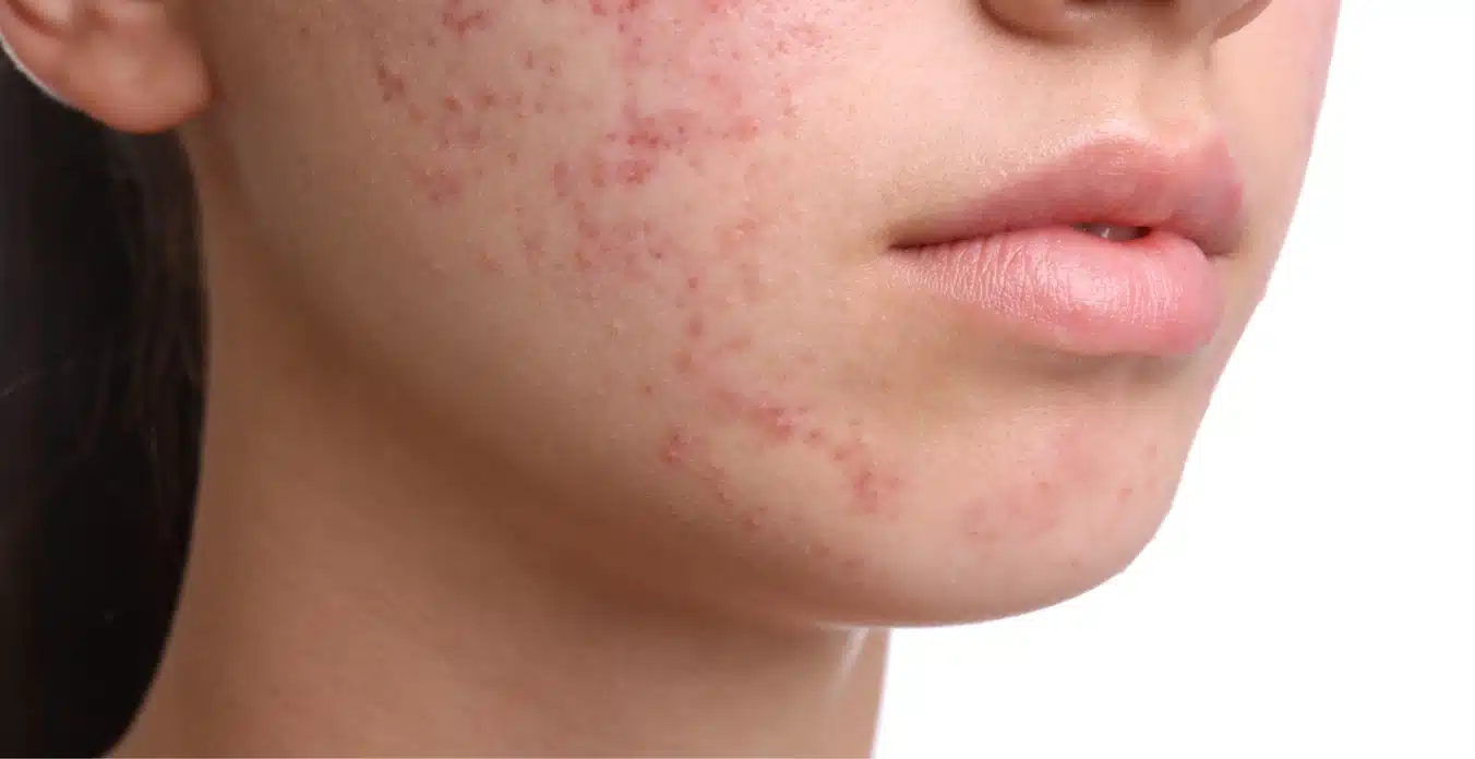 Severe Acne Treatment With Roaccutane (Isotretinoin)