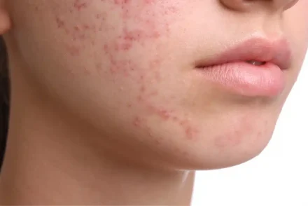 Severe Acne Treatment With Roaccutane (Isotretinoin)